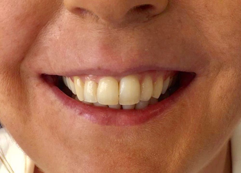 donna-6-month-braces-after